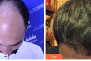 廊坊華康醫(yī)療美容門診部董海英整形價格表附頭頂加密種植案例展示