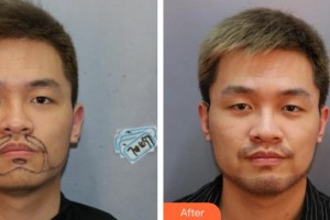 廊坊榮霞醫(yī)療美容診所代金榮整形價格表附種植胡須案例展示