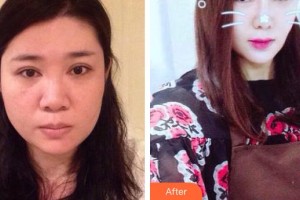 廊坊榮霞醫(yī)療美容診所柴慶勛整形價格表附眼部綜合案例展示