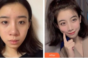 廊坊頤美佳醫(yī)療美容醫(yī)院范金財整形價格表附鼻部綜合案例展示