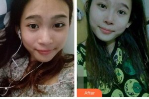 廊坊榮霞醫(yī)療美容診所常秀芬整形價格表附鼻部綜合案例展示