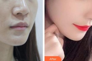 廊坊瑞美慧醫(yī)療美容診所韓增鵬整形價格表附鼻部綜合案例展示