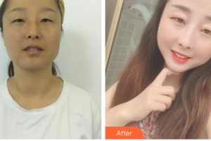 廊坊頤美佳醫(yī)療美容醫(yī)院蔣海越整形價格表附白瓷娃娃案例展示