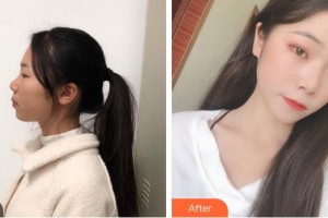 衡水天宏醫(yī)療美容醫(yī)院李正燁整形價(jià)格表附光子嫩膚案例展示