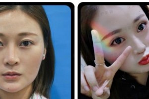 衡水唯美醫(yī)療美容門(mén)診部田振宇整形價(jià)格表附自體脂肪全臉填充案例展示