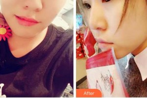 衡水愛爾眼科醫(yī)院姚艷整形價格表附切開雙眼皮案例展示