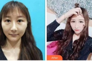 衡水愛(ài)爾眼科醫(yī)院王娣娜整形價(jià)格表附切開(kāi)雙眼皮案例展示