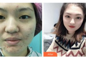 衡水愛(ài)爾眼科醫(yī)院韓賢奎整形價(jià)格表附眼部綜合案例展示