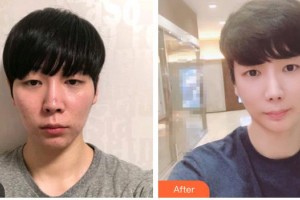 衡水愛(ài)爾眼科醫(yī)院賈艷青整形價(jià)格表附眼部修復(fù)案例展示