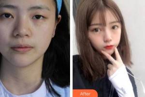 衡水愛(ài)爾眼科醫(yī)院趙勇整形價(jià)格表附切開(kāi)雙眼皮案例展示