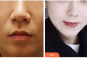 衡水尚美醫(yī)療美容門(mén)診部馮小軍整形價(jià)格表附埋線(xiàn)提升案例展示