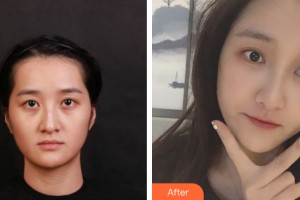 蘭州黛美爾醫(yī)學美容醫(yī)院任文明整形價格表附自體脂肪填充案例展示