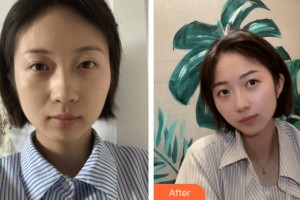 蘭州嘉琳醫(yī)學美容醫(yī)院加曉東整形價格表附皮膚美容案例展示