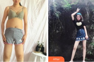 蘭州時光整形美容醫(yī)院易普峰整形價格表附大腿吸脂案例展示