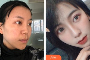 蘭州美月整形美容醫(yī)院齊云香整形價格表附鼻部手術(shù)案例展示