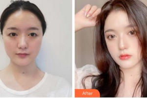 蘭州崔大夫醫(yī)療美容門診部王埴鋮整形價格表附眼部手術(shù)案例展示