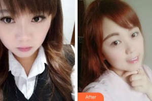 蘭州市口腔醫(yī)院李雪蓮整形價格表附牙齒矯正案例展示