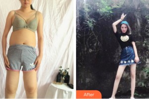 柳州美麗焦點醫(yī)療美容門診部陳毓南整形價格表附大腿吸脂案例展示