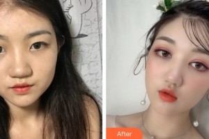 貴陽華美整形美容醫(yī)院戚琪整形價格表附眼部手術案例展示