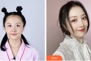 貴陽中醫(yī)皮膚病醫(yī)院植發(fā)中心張芳勇整形價格表附植發(fā)案例展示