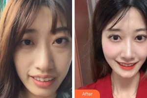 三亞泰康拜博口腔醫(yī)院劉曉峰整形價(jià)格表附牙齒矯正案例展示