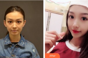 三亞韓氏醫(yī)療美容門診部劉玉剛整形價(jià)格表附自體脂肪填充案例展示