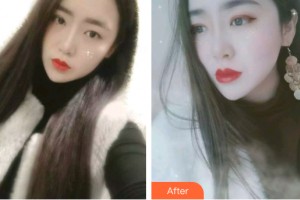 三亞泰康拜博口腔醫(yī)院鐘家純整形價(jià)格表附牙齒矯正案例展示