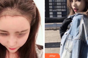 西寧夏都醫(yī)療美容醫(yī)院雷克整形價格表附植發(fā)案例展示