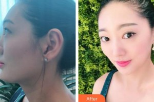 臨汾憶佳星醫(yī)療美容門診部李奕得整形價(jià)格表附鼻部綜合案例展示