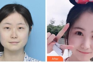 臨汾市堯都區(qū)眼科醫(yī)院張愛當(dāng)整形價(jià)格表附切開雙眼皮案例展示