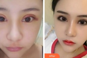 臨汾市堯都區(qū)眼科醫(yī)院趙曉娟住院醫(yī)師整形價(jià)格表附切開雙眼皮案例展示