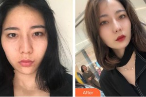 臨汾佳美醫(yī)療整形醫(yī)院劉丹整形價(jià)格表附白瓷娃娃案例展示