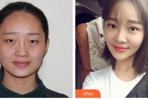 內(nèi)蒙古榮軍醫(yī)院整形美容科張啟凌整形價(jià)格表附光子嫩膚案例展示