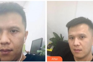 內(nèi)蒙古藍(lán)天整形醫(yī)院趙鋼整形價(jià)格表附去痘印痘坑案例展示