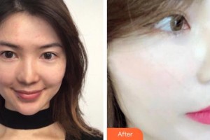 內(nèi)蒙古醫(yī)科大學(xué)附屬醫(yī)院整形美容燒傷科姜葵福整形價(jià)格表附光子嫩膚案例展示