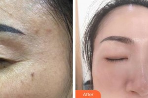 內(nèi)蒙古慕顏醫(yī)療美容門(mén)診部賈慧敏整形價(jià)格表附激光祛斑案例展示