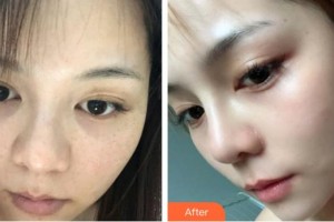 內(nèi)蒙古慕顏醫(yī)療美容門(mén)診部劉丹丹整形價(jià)格表附激光祛斑案例展示