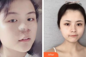 內(nèi)蒙古永泰整形美容醫(yī)院王春燕整形價(jià)格表附祛斑祛痣案例展示