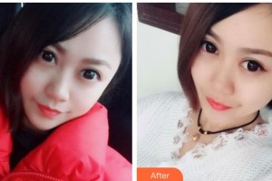 內(nèi)蒙古盛禧醫(yī)療美容門(mén)診部史栗豐整形價(jià)格表附激光點(diǎn)痣案例展示