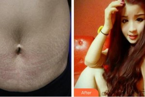 內(nèi)蒙古盛禧醫(yī)療美容門(mén)診部程芳芳整形價(jià)格表附祛妊娠紋案例展示