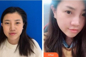 內(nèi)蒙古藍(lán)天整形醫(yī)院黃寅守整形價(jià)格表附白瓷娃娃案例展示