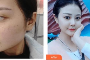 呼和浩特閆小林醫(yī)療美容門診部閆小林整形價(jià)格表附激光祛斑案例展示