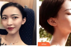 呼和浩特閆小林醫(yī)療美容門診部張樸整形價格表附光子嫩膚案例展示