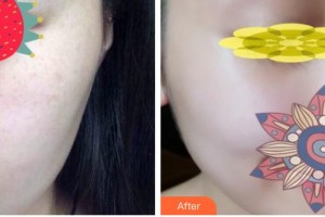 呼和浩特吳老貴醫(yī)學美容診所吳老貴整形價格表附微針水光案例展示