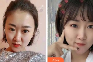 呼和浩特市第一醫(yī)院醫(yī)療整形美容中心武劍茹整形價格表附紅藍光祛痘案例展示