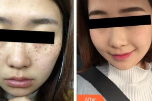 呼和浩特維科美容整形診所李明陽整形價格表附激光祛斑案例展示