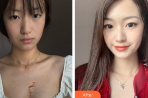 呼和浩特任榮大韓醫(yī)療美容診所閆小宇整形價格表附微創(chuàng)疤痕修復案例展示