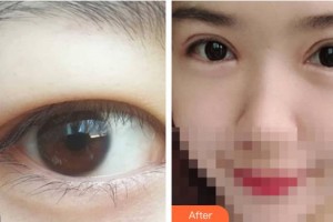 呼和浩特維科美容整形診所辛來整形價格表附切開雙眼皮案例展示