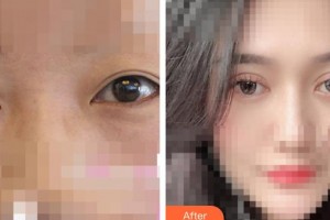 呼和浩特閆德雄醫(yī)療美容診所邊慧娟整形價格表附眼部綜合案例展示