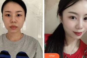 呼和浩特京美醫(yī)療形美容醫(yī)院李慧整形價(jià)格表附眼部綜合案例展示